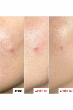 Best Gel effet patch anti-imperfections Centella SOS Patch Anti-Imperfection & Rougeurs|Soin De Nuit