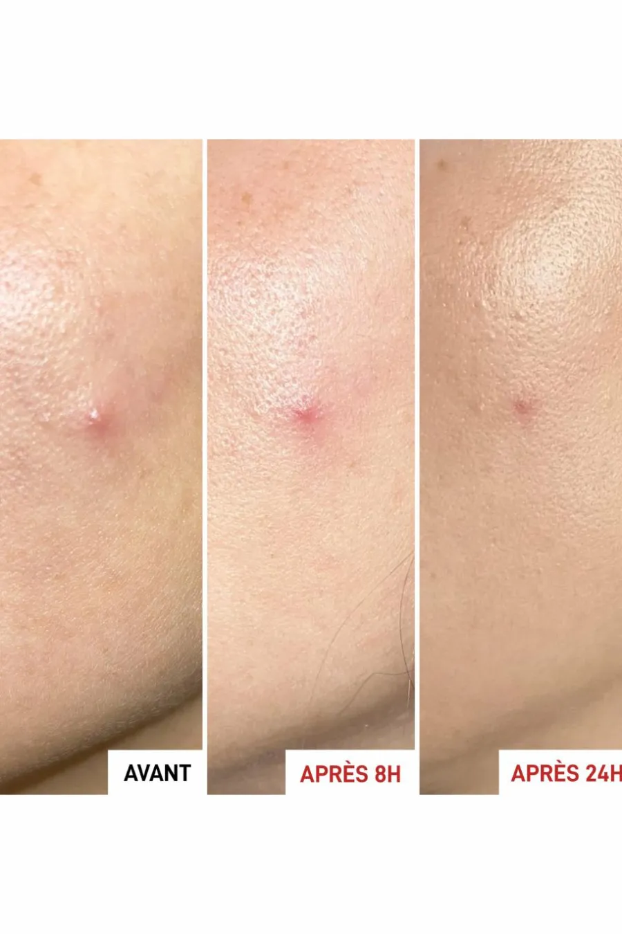 Best Gel effet patch anti-imperfections Centella SOS Patch Anti-Imperfection & Rougeurs|Soin De Nuit